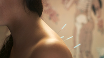 Acupuncture
